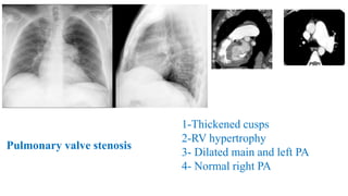 1-Thickened cusps
2-RV hypertrophy
3- Dilated main and left PA
4- Normal right PA
Pulmonary valve stenosis
 
