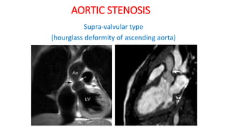 AORTIC STENOSIS
Supra-valvular type
(hourglass deformity of ascending aorta)
 