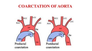 COARCTATION OF AORTA
 