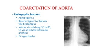 • Radiographic features:
• Aortic figure 3
• Reverse figure 3 of Barium
filled esophagus
• Inferior rib notching (3rd to 8th,
>8 yrs, dt dilated intercostal
arteries)
• LV hypertrophy
COARCTATION OF AORTA
 