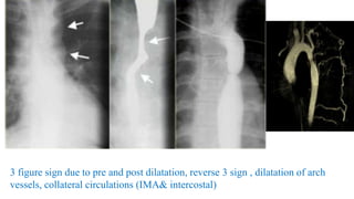 3 figure sign due to pre and post dilatation, reverse 3 sign , dilatation of arch
vessels, collateral circulations (IMA& intercostal)
 