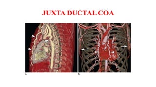 JUXTA DUCTAL COA
 