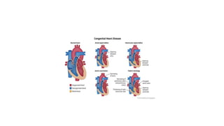 Congenital heart diseases during pregnancy | PPTX