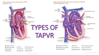 Cyanotic heart diseases | PPTX