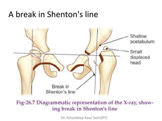 Congenital hip dislocation | PPTX