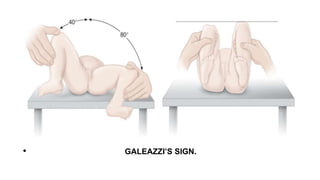 Congenital hip disease | PPTX