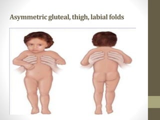 Asymmetricgluteal,thigh,labialfolds
 