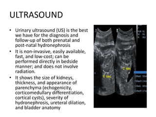 ULTRASOUND
• Urinary ultrasound (US) is the best
we have for the diagnosis and
follow-up of both prenatal and
post-natal hydronephrosis
• It is non-invasive, easily available,
fast, and low-cost; can be
performed directly in bedside
manner; and does not involve
radiation.
• It shows the size of kidneys,
thickness, and appearance of
parenchyma (echogenicity,
corticomedullary differentiation,
cortical cysts), severity of
hydronephrosis, ureteral dilation,
and bladder anatomy
 