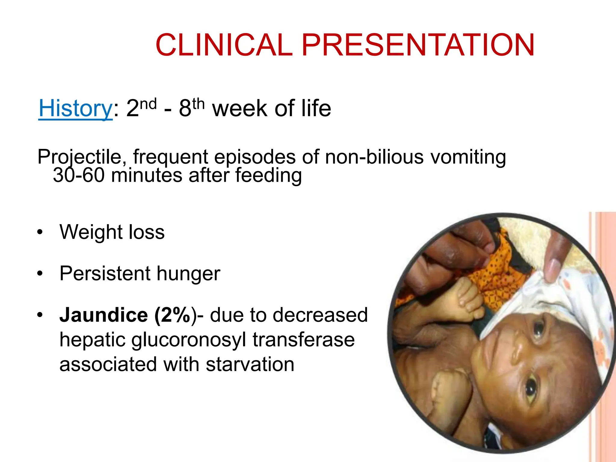 congenitalhypertrophicpyloricstenosis.pptx