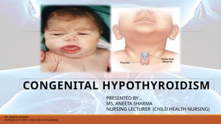 CONGENITAL HYPOTHYROIDISM
PRESENTED BY ..
MS. ANEETA SHARMA
NURSING LECTURER (CHILD HEALTH NURSING)
MS. ANEETA SHARMA
NURSING LECTURER (CHILD HEALTH NURSING)
 