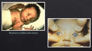 Muffin Rash eye manifestation of intrauterine infection | PPTX