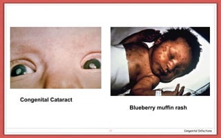 Congenital infections zac | PPTX