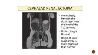 Kidney Rotation Congenital Kidney Anomalies * ANOMALIES OF RENAL NUMBER * ANOMALIES OF ...