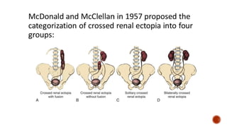 Kidney Rotation Congenital Kidney Anomalies * ANOMALIES OF RENAL NUMBER * ANOMALIES OF ...