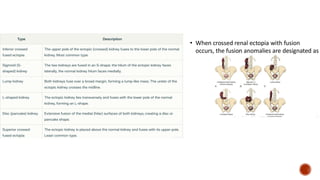 Kidney Rotation Congenital Kidney Anomalies * ANOMALIES OF RENAL NUMBER * ANOMALIES OF ...
