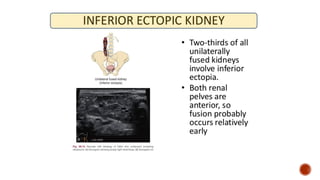 Kidney Rotation Congenital Kidney Anomalies * ANOMALIES OF RENAL NUMBER * ANOMALIES OF ...