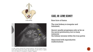 Kidney Rotation Congenital Kidney Anomalies * ANOMALIES OF RENAL NUMBER * ANOMALIES OF ...