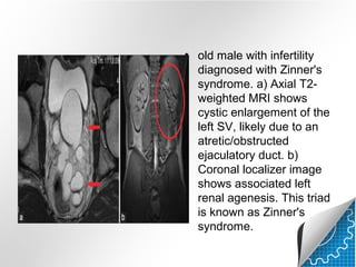 Rinner Abnormal Congenital kidney disease in Radiology | PPT