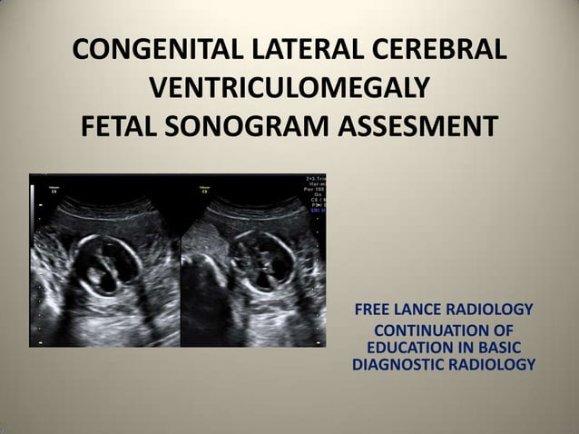 Congenital lateral ventriculomegaly PPTX