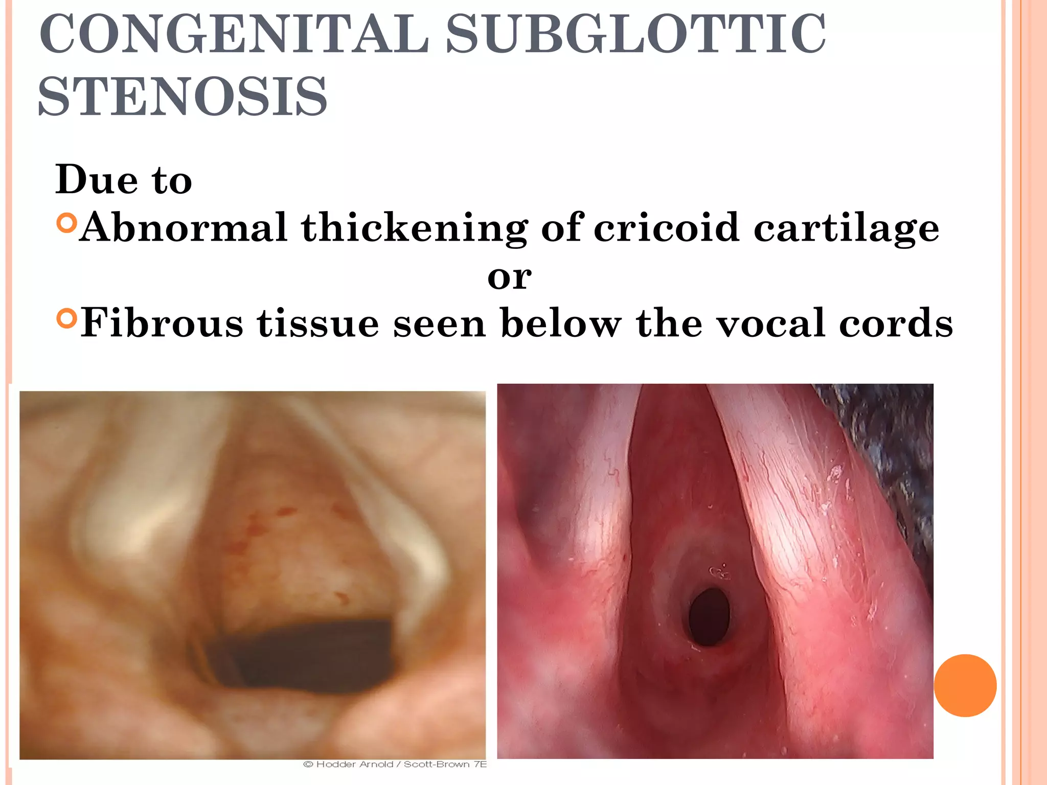 Congenital lesions of larynx and stridor management | PPT