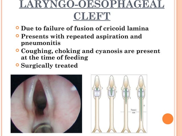 Congenital lesions of larynx and stridor management | PPT
