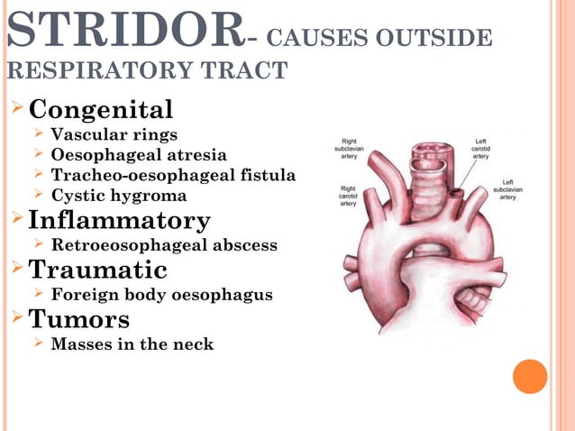 Congenital lesions of larynx and stridor management | PPT