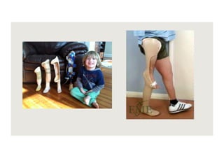 Congenital Limb deficiencies. Physiotherapy for pediatrics.pdf