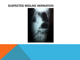 SUSPECTED MIDLINE HERNIATION
 