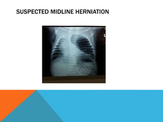 SUSPECTED MIDLINE HERNIATION
 