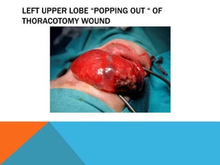 LEFT UPPER LOBE “POPPING OUT “ OF
THORACOTOMY WOUND
 