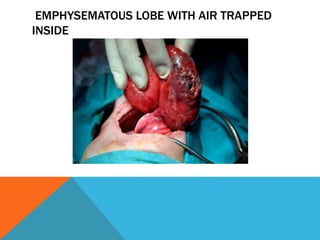 EMPHYSEMATOUS LOBE WITH AIR TRAPPED
INSIDE
 