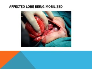 AFFECTED LOBE BEING MOBILIZED
 