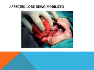 AFFECTED LOBE BEING MOBILIZED
 