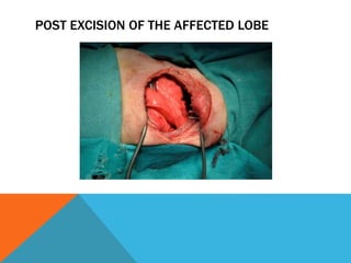 POST EXCISION OF THE AFFECTED LOBE
 