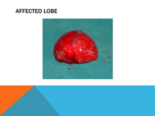 AFFECTED LOBE
 