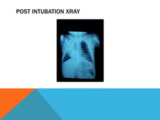 POST INTUBATION XRAY
 