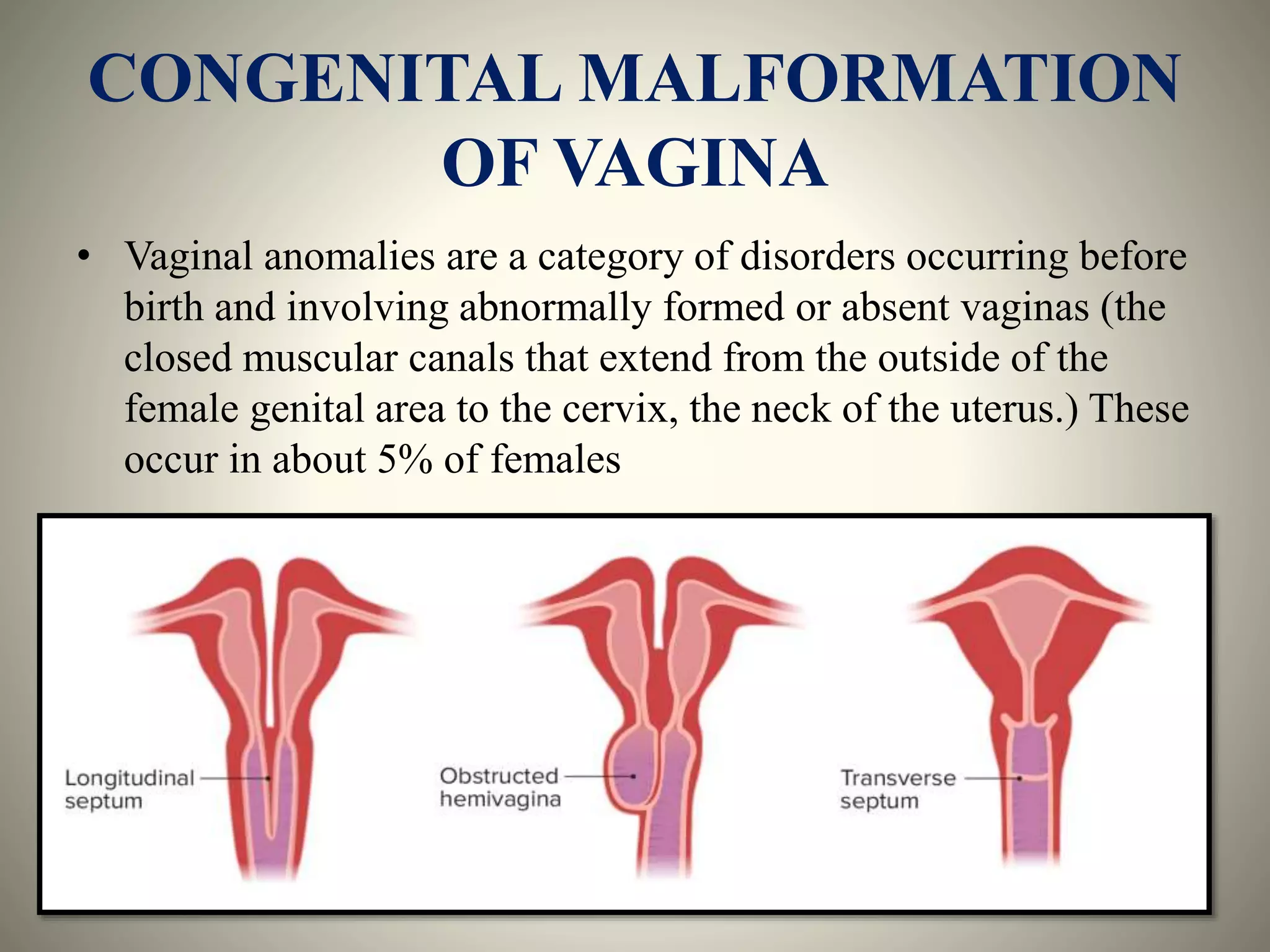 CONGENITAL MALFORMATION OF UTERUS AND VAGINA 2.pptx