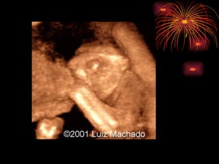 CONGENITAL MALFORMATIONS gogo.ppt cfmf   n