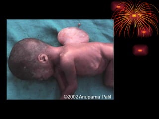 CONGENITAL MALFORMATIONS gogo.ppt cfmf   n