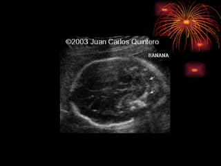 CONGENITAL MALFORMATIONS gogo.ppt cfmf   n