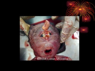 CONGENITAL MALFORMATIONS gogo.ppt cfmf   n