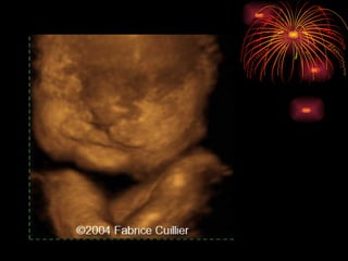 CONGENITAL MALFORMATIONS gogo.ppt cfmf   n