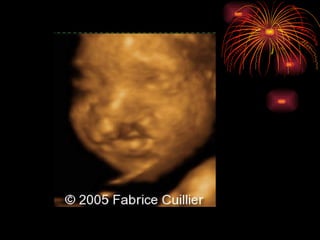 CONGENITAL MALFORMATIONS gogo.ppt cfmf   n