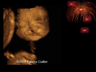 CONGENITAL MALFORMATIONS gogo.ppt cfmf   n