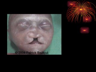 CONGENITAL MALFORMATIONS gogo.ppt cfmf   n