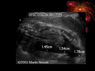 CONGENITAL MALFORMATIONS gogo.ppt cfmf   n
