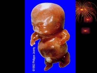 CONGENITAL MALFORMATIONS gogo.ppt cfmf   n