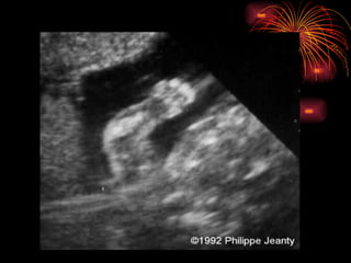 CONGENITAL MALFORMATIONS gogo.ppt cfmf   n