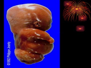 CONGENITAL MALFORMATIONS gogo.ppt cfmf   n