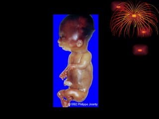 CONGENITAL MALFORMATIONS gogo.ppt cfmf   n